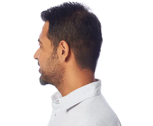 Homem usando aparelho auditivo microcanal invisível IIC